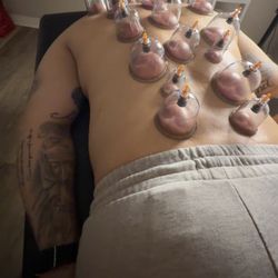 Cupping 