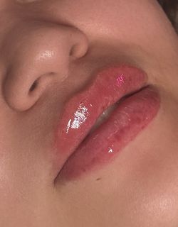 Lip Fillers 