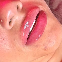 Fillers