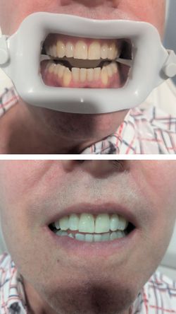 Teeth whitening