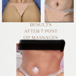 Post Op Massages 