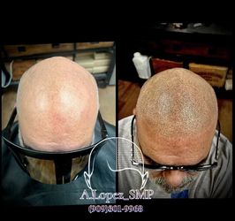 Hair Loss