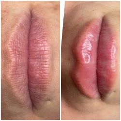 Hyaluron Lip Fill