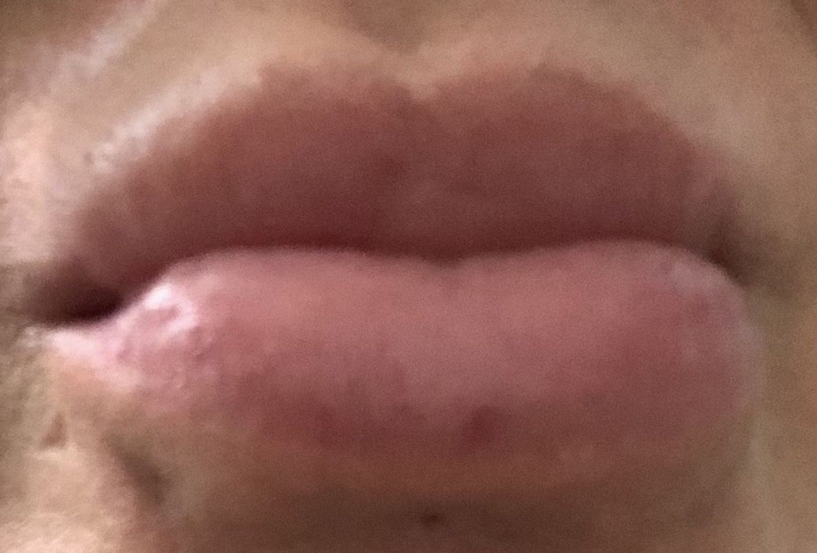 Lip Filler