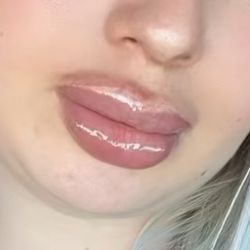 Aumento De Labios 