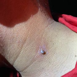 Yo Remuevo Verrugas, Contácteme.