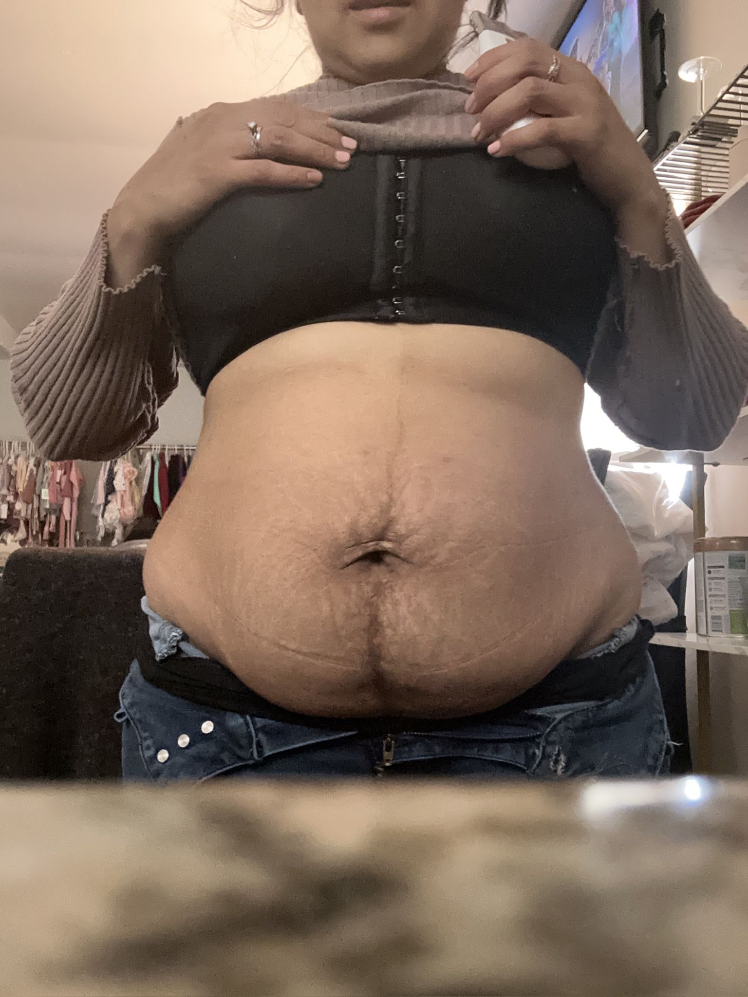 STRETCH MARKS REMOVAL 