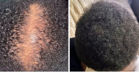 Herbal hair growth oil 🌿