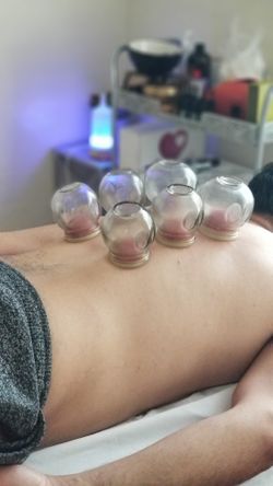 Cupping therapy