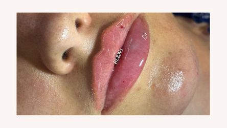 Hyaluronic Acid Fillers