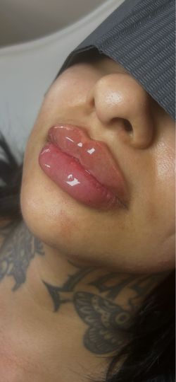 Lip filler models💉