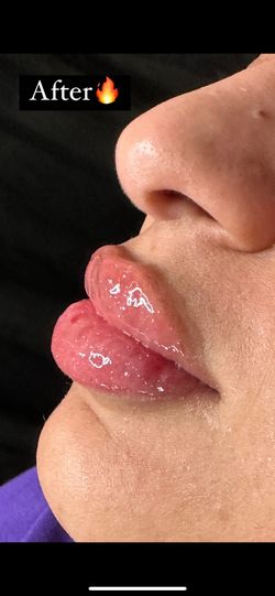 Lip Pumpers