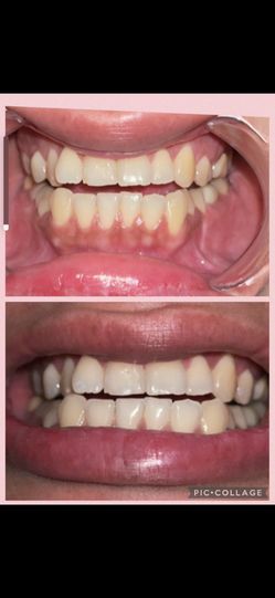Teeth Whitening