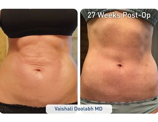 Freee Slim Tightening