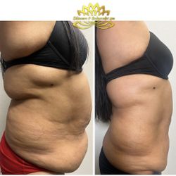 Stomach Fat Reduction