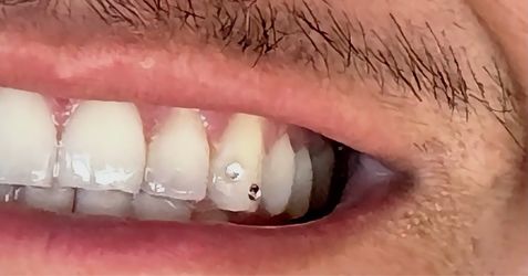 Tooth Gems