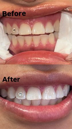 Teeth Whitening & Tooth Gems