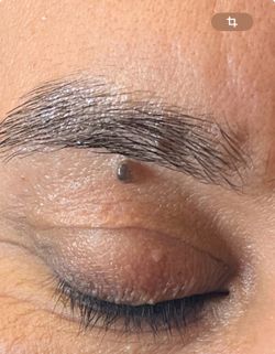 eliminación de verrugas con plasma pen 