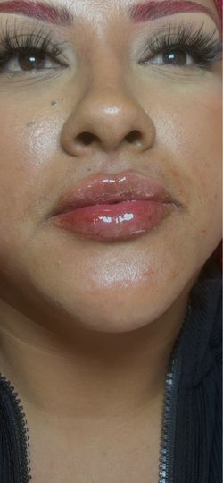 LIP FILLER MODELS