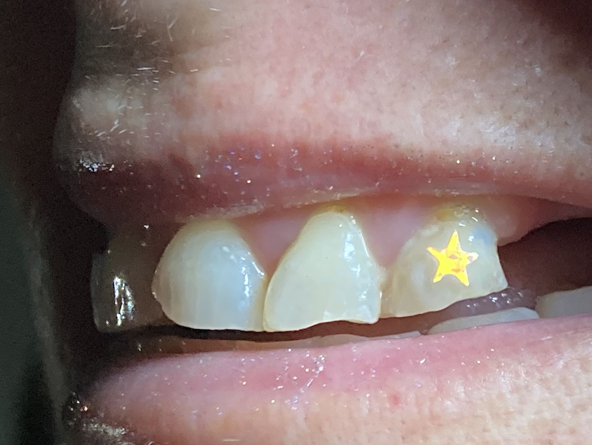 Tooth Gems 