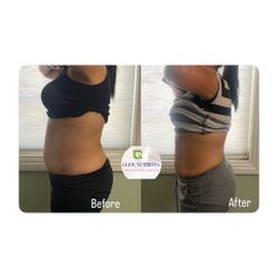Body Sculpting