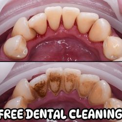FREE DENTAL CLEANING 