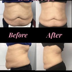 Lipo Massage