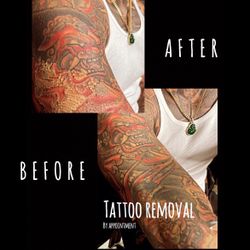 Tattoo Removal