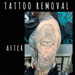 Removal