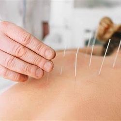 Acupuncture 