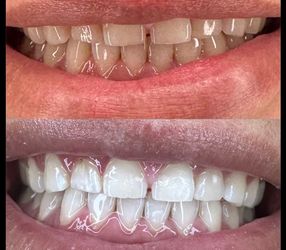 Teeth Whitening