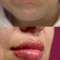 relleno de labios