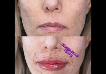 Skin Tightening