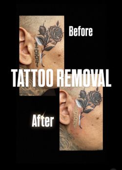Removal