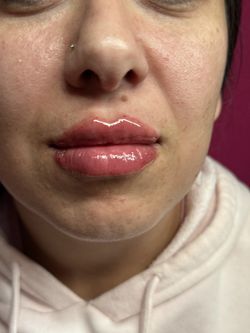 Lip Filler