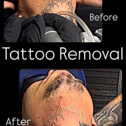 Removal