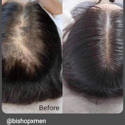 Solution For Hairloss 