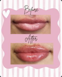 Lip filler