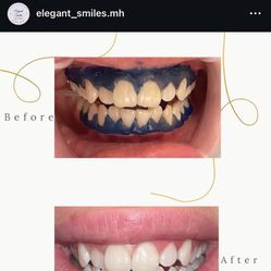 Teeth Whitening 