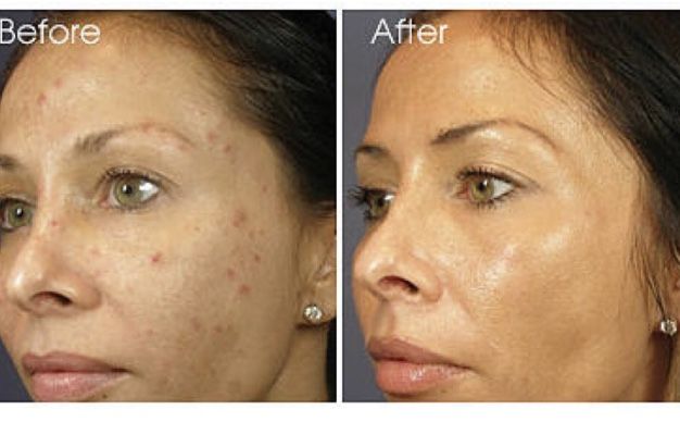 Skin Brightening Serum More Potent Than Mequinol