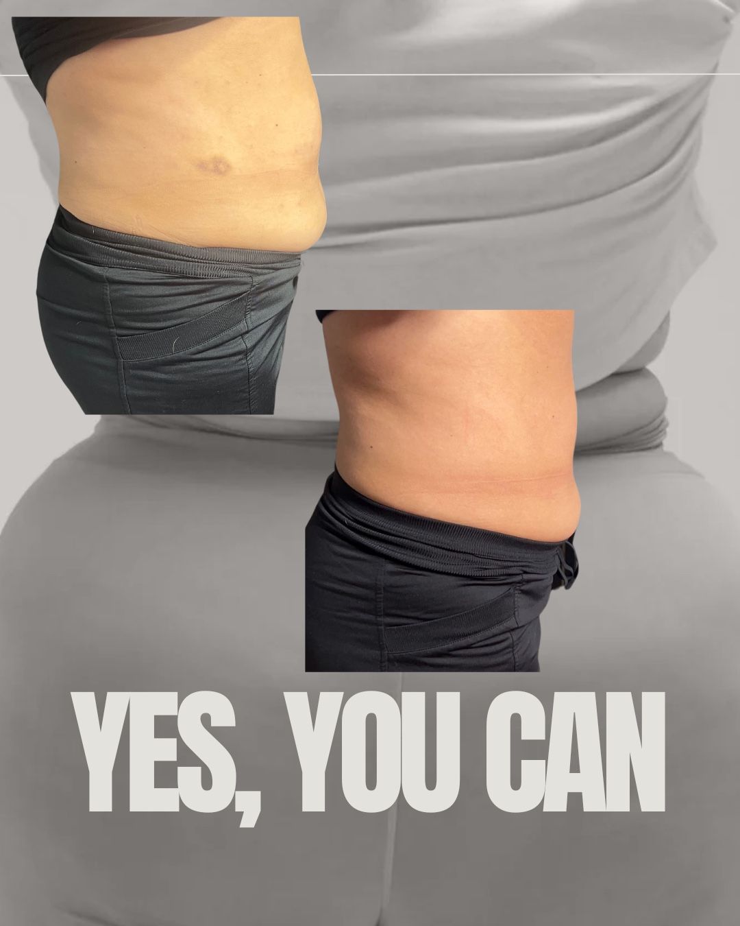 Lipo Papada Lipo Abdomen Con HYALURON Pen