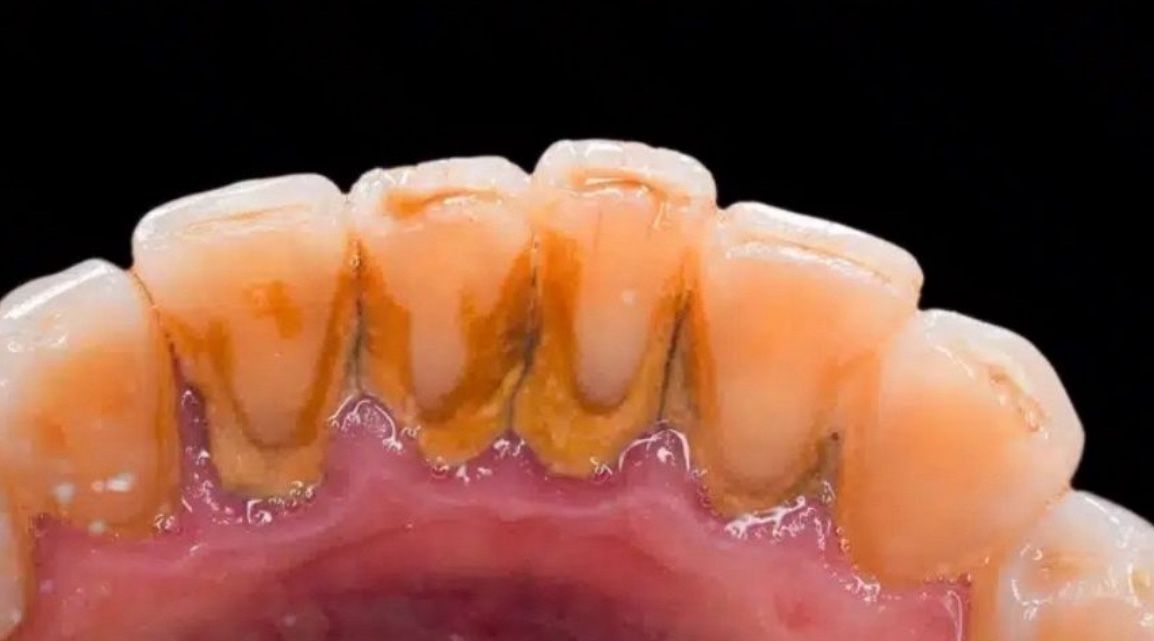 Free Dental Cleaning