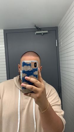 Loosing your hair hair line is not the same anymore ?