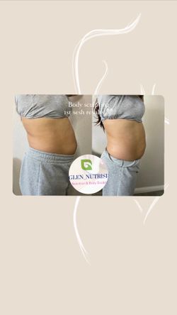 Body Sculpting Stomach Area Cavitation R F And More