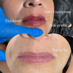 Hyaluron pen Lips