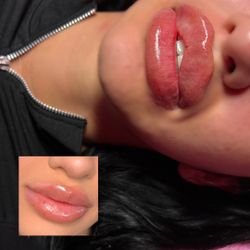 Aumento De Labios