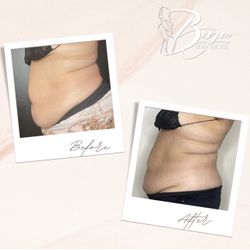 Body Sculpting