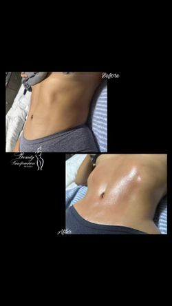 Lymphatic Massage