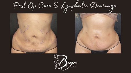 Post Op Lymphatic Massage