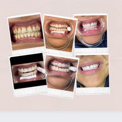 Teeth Whitening